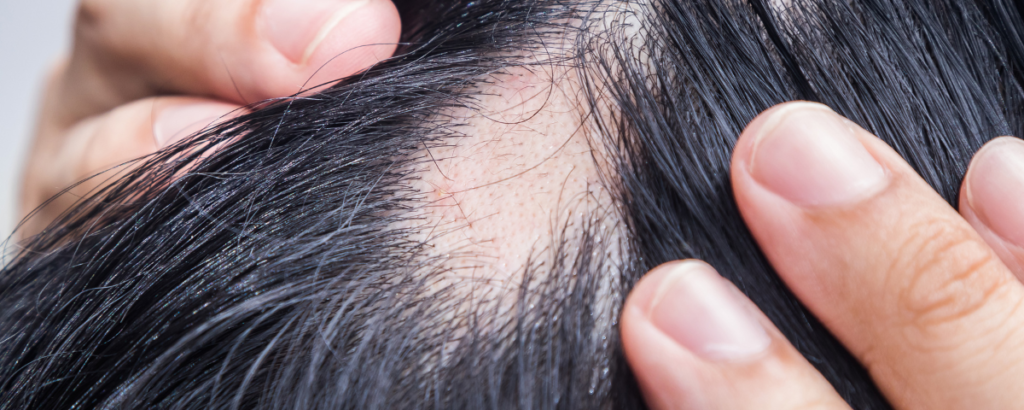 Alopecia areata