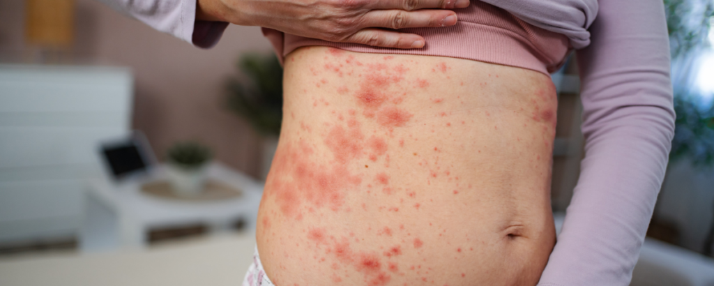Dermatite herpetiforme