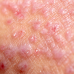 Doença celíaca e dermatite herpetiforme