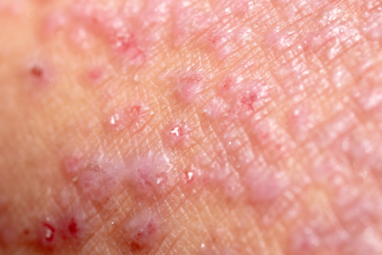 Doença celíaca e dermatite herpetiforme