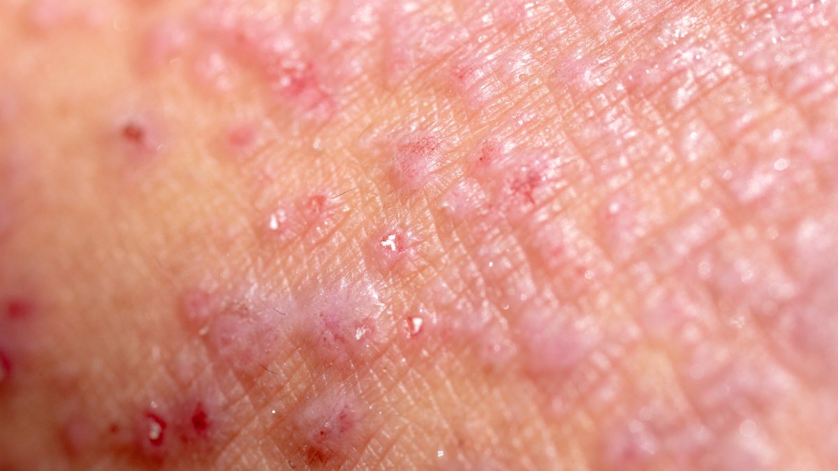 Doença celíaca e dermatite herpetiforme