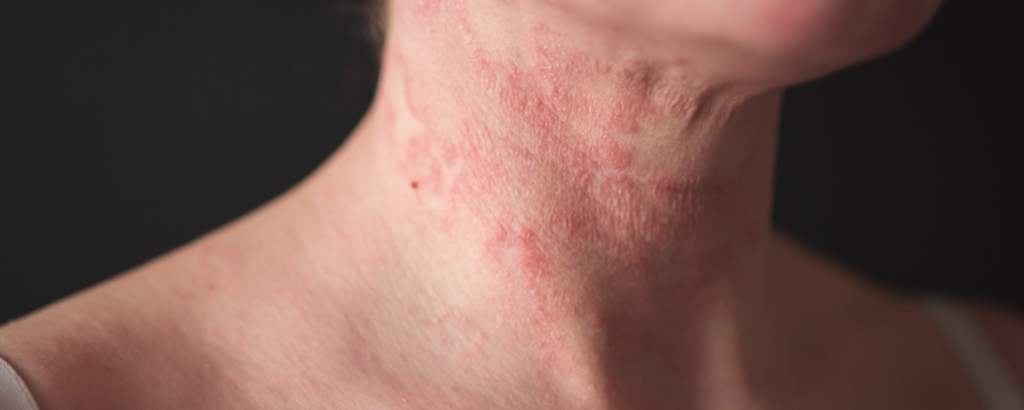Eczema