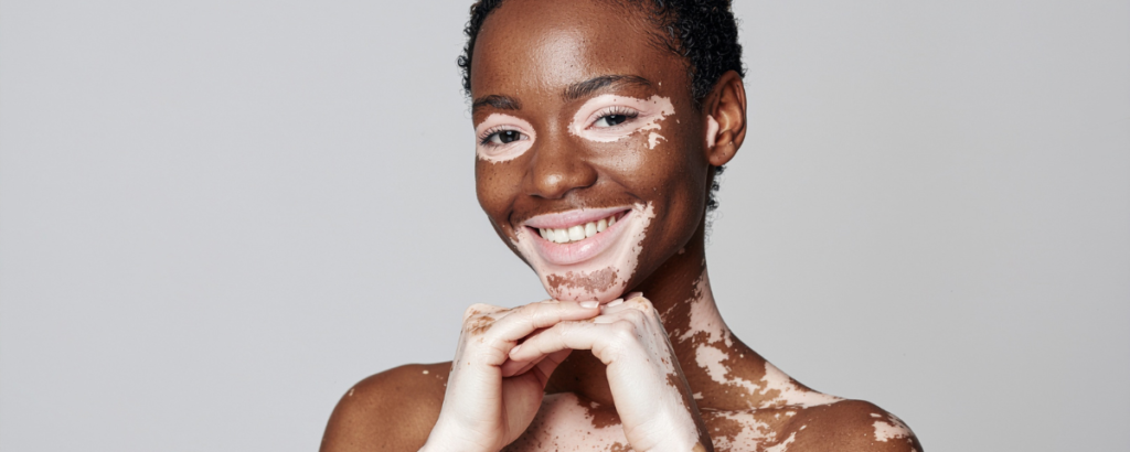Vitiligo