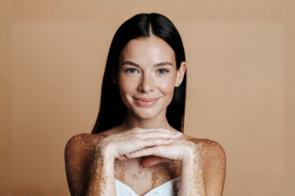 Vitiligo e doença celíaca