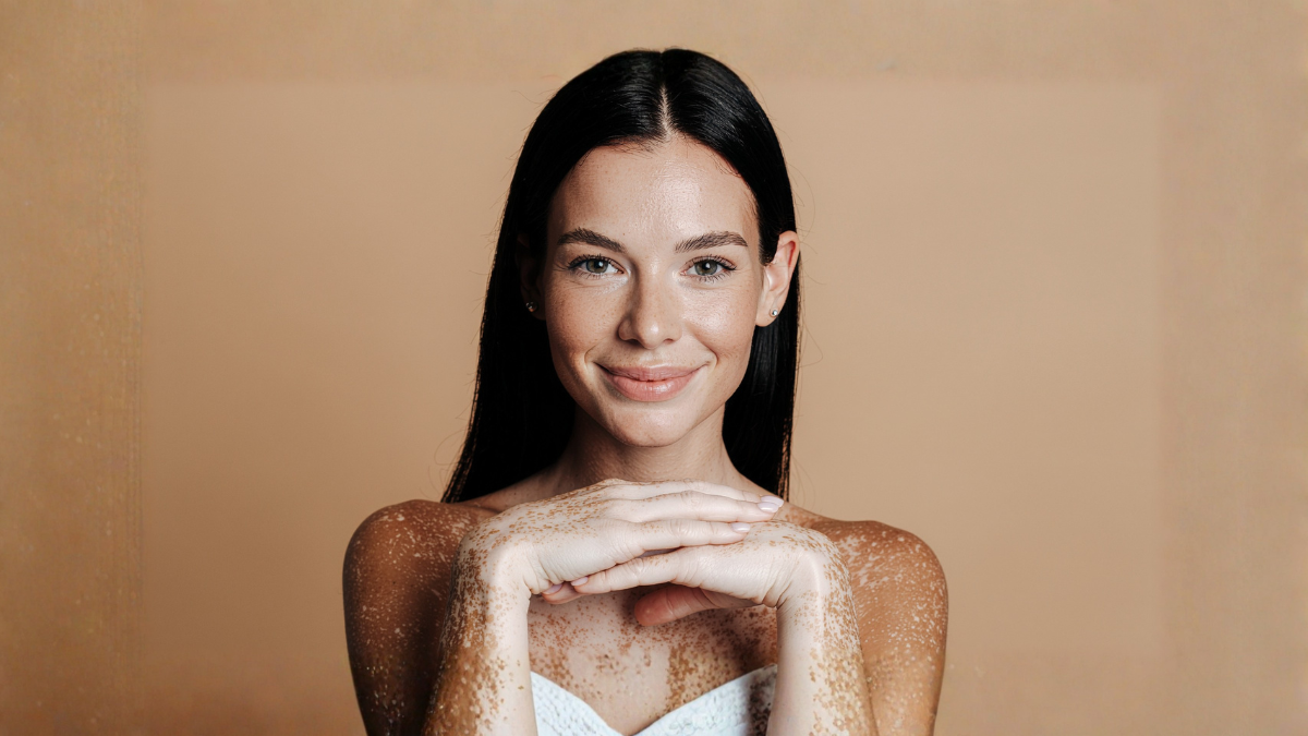 Vitiligo e doença celíaca