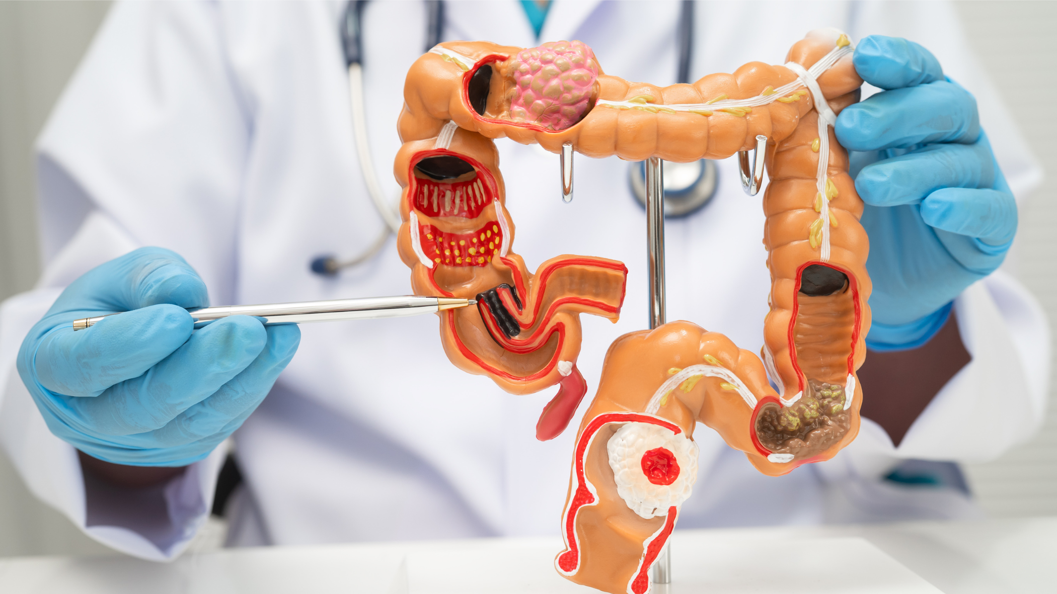 doenças autoimunes do intestino