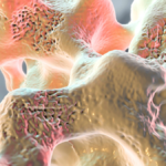 osteoporose