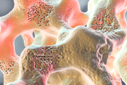 osteoporose