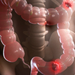 síndrome do intestino irritável