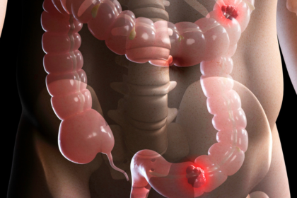 síndrome do intestino irritável